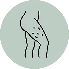 Cellulite Is a Support Problem, Not a Skin Problem